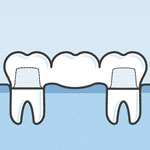 dental-bridge-cartoon-sq-150