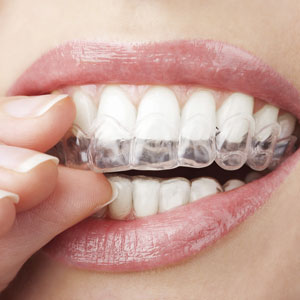 invisible-braces-sq-300