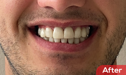 Before and after-10