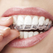 invisible-braces-sq-175