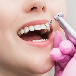 Teeth Whitening