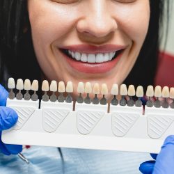 Veneers-2